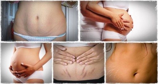 How To Remove Stretch Marks