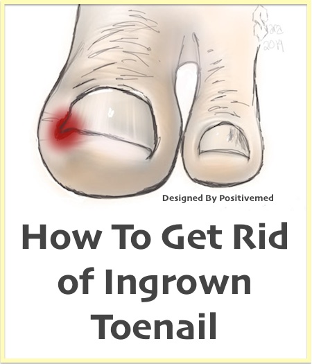 How To Get Rid Of Ingrown Toenails 2