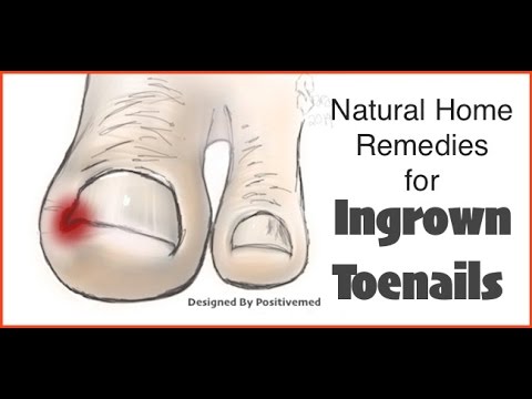 How To Get Rid Of Ingrown Toenails