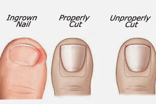 get-rid-of-ingrown-toenails