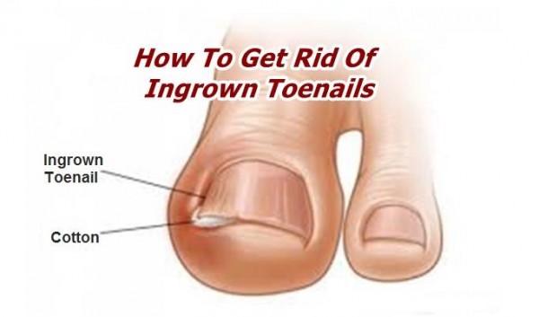 How To Get Rid Of Ingrown Toenails 4
