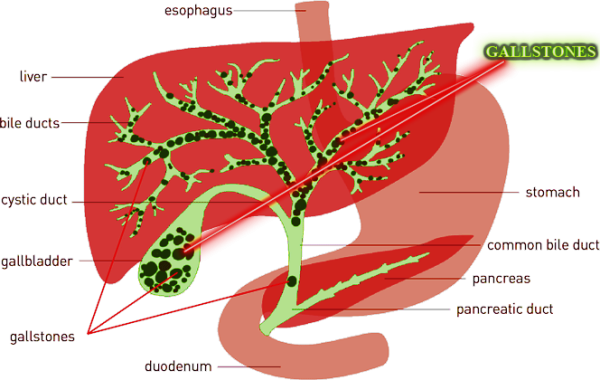 Liver Cleanse How To Get Rid Of Liver Stones Safely In 24 Hours 1