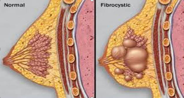 Natural Cure For Cysts