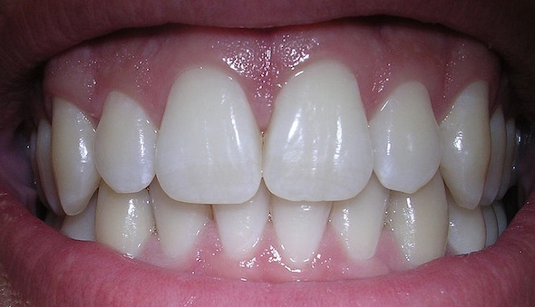 A Holistic Approach For Gum Disease And Cavities