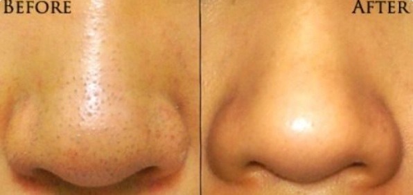 How To Remove Blackheads