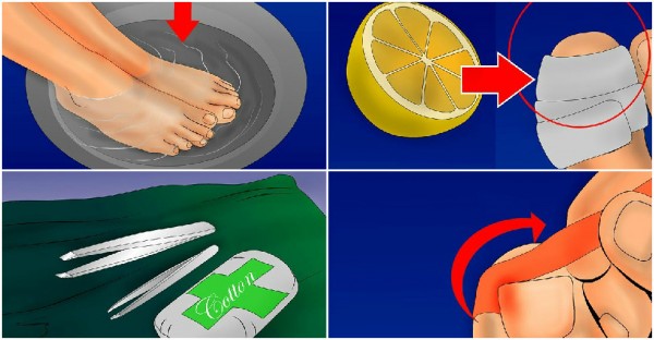 Home Remedies For Ingrown Toenails