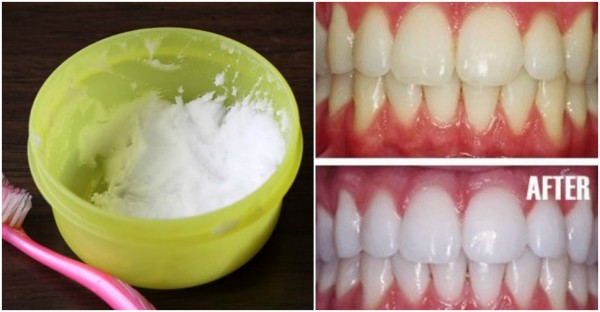 How To Whiten Teeth At Home