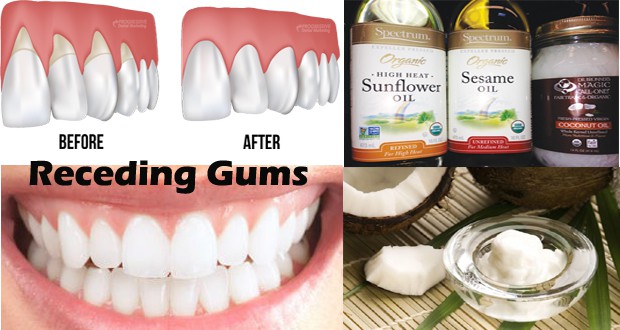 Receding Gums