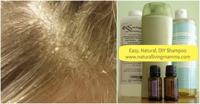 Homemade Anti-Dandruff Shampoo Recipe