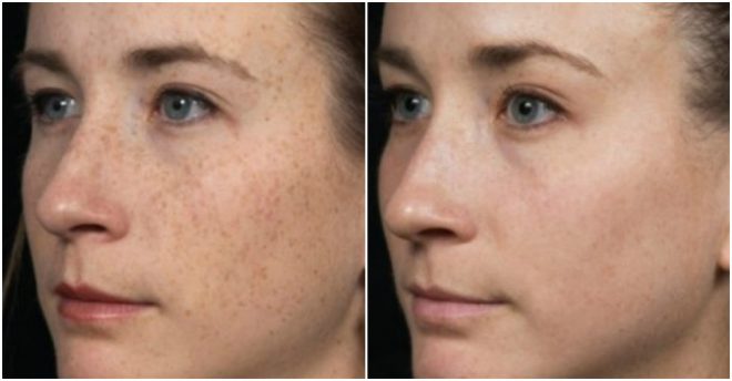 how-to-remove-brown-spots-on-skin