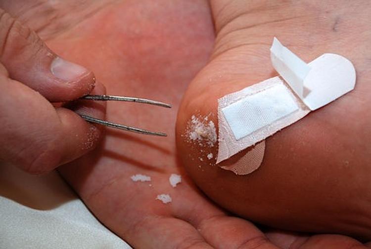 How To Remove A Splinter With Baking Soda How To Instructions